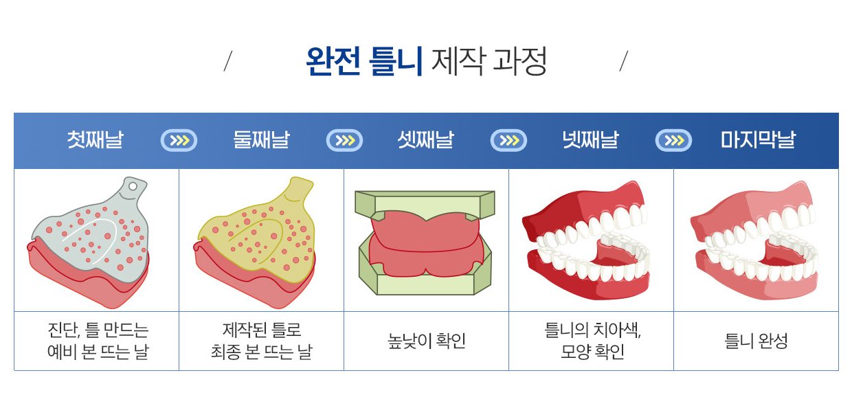 완전틀니 제작 과정 그림