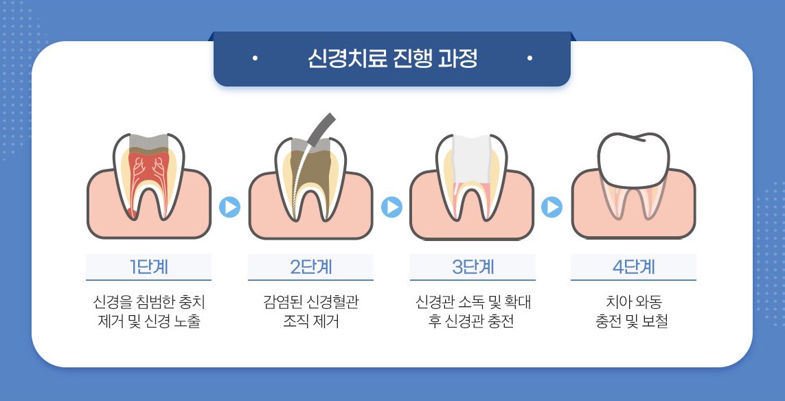 신경치료 진행 과정 4단계 그림