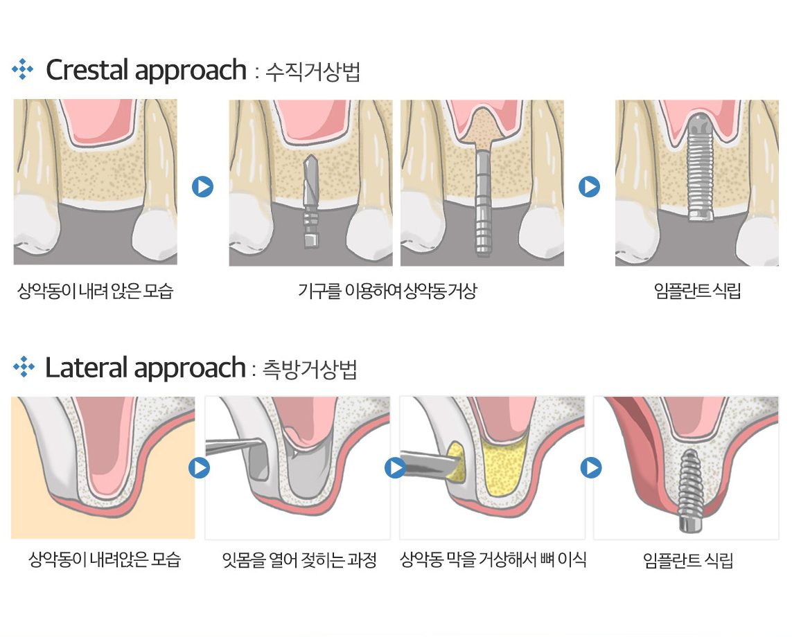 상악동 거상술(수직·측방) 과정 그림